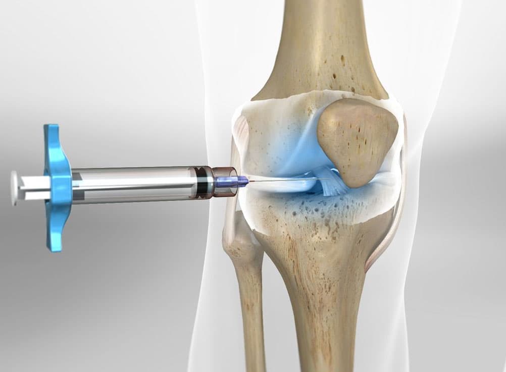 3D illustration of knee joint injection mechanism