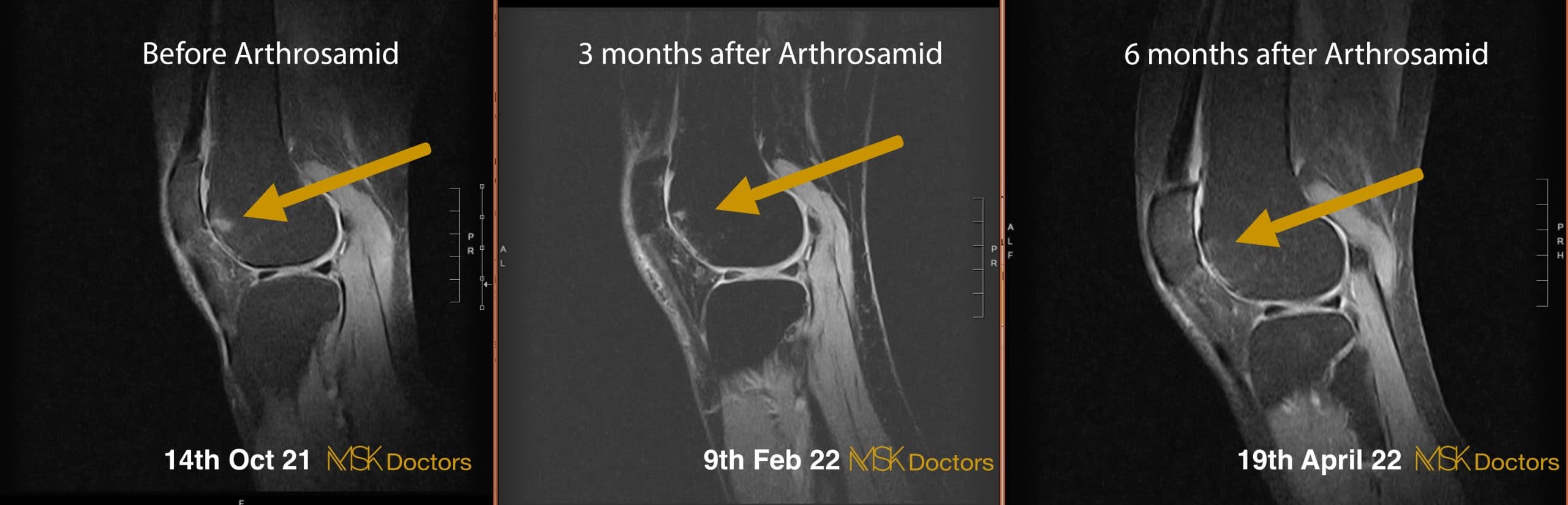 MRI sequence demonstrating knee joint changes over time with Arthrosamid® treatment
