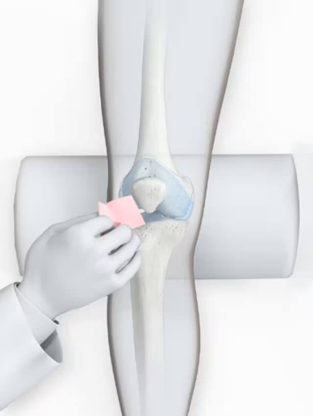 Knee prepared and cleaned before Arthrosamid injection