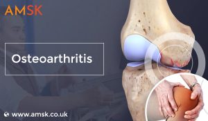 Osteoarthritis